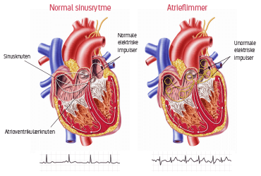 Hjerte med normal sinusrytme og hjerte med atrieflimmer